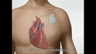 Pacemaker Treatment in India at affordable Cost